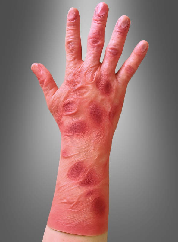 Ein verbrannte Haut Handschuh Freddy